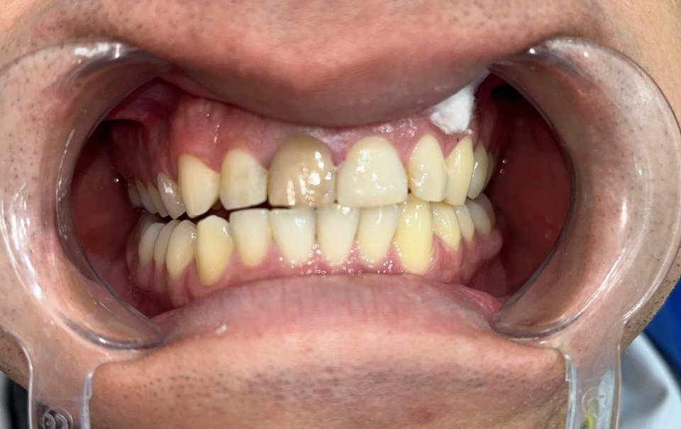 Antes del blanqueamiento