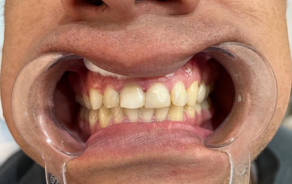 Después del blanqueamiento