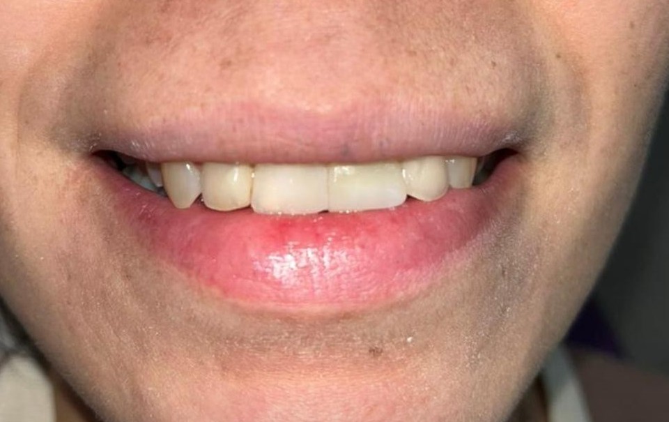 Después del implante